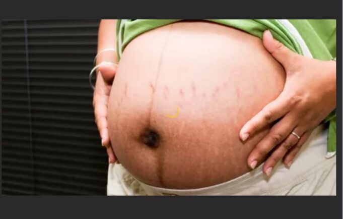How to Control The Spread Of Stretch Marks As A Pregnant Woman